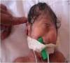 تولد نوزاد یک چشم در عراق !
