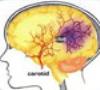 آزمایش دارویی جدید برای پیشگیری از عوارض سکته مغزی