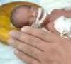 تولد نوزادی که قلبش خارج از سینه می تپد