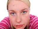

یکی از بدترین و ناخوشایندترین نوع جوش‌هایی که بر روی پوست به خصوص پوست صورت ظاهر می‌شود جوش‌های چرکی هستند که دلایل و راه‌های برخورد یا همان درمان مختلفی دارند
