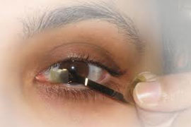 افراد نابینا در امریکا در انتظار تائیدیه سازمان غذا و داروی این کشور برای استفاده از شبکیه مصنوعی چشم هستند.
