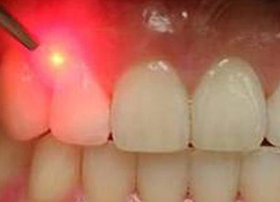 یک دندانپزشک معتقد است: چنانچه جرم گیری دندان توسط افراد متخصص انجام شود، هیچ گونه آسیبی به دندانها نمی رسد.
