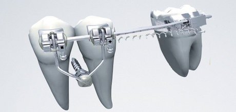 محققان مرکز رشد دانشگاه آزاد اسلامی زنجان، با استفاده از هیدروکسید کلسیم پانسمانی برای کاهش دردهای دندانی با خاصیت ضدپوسیدگی تولید کردند.

