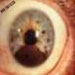 پژوهشگران با استفاده از روش ترموشیمی درمانی تومورهای چشمی را از بین می برند.
