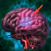 نتایج یک مطالعه نشان می‌دهد اضطراب خطر ابتلا به سکته مغزی را در حد قابل توجهی افزایش می‌دهد.